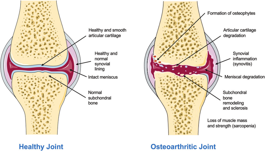 schematic illustrating a healthy knee joint and an osteoarthritic knee joint this figure