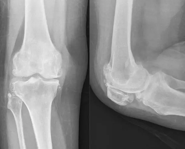 Unlocking Joint Youth: How Inhibiting 15-PGDH Could Redefine Osteoarthritis Treatment Unlocking Joint Youth: How Inhibiting 15-PGDH Could Redefine Osteoarthritis Treatment - EAZYHEALTH