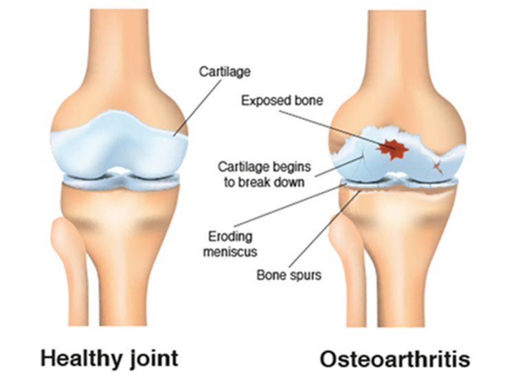 comparision between a healthy joint and a knee joint with osteoarthritis